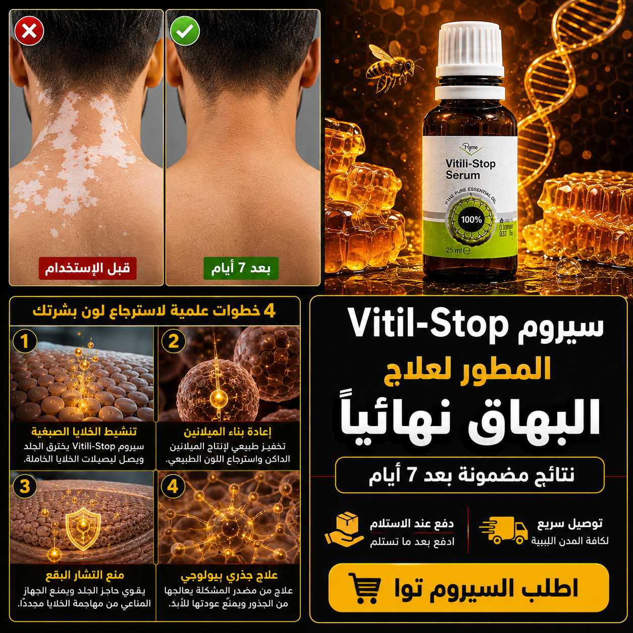سيروم علاج البهاق و البرص التركي