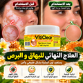 كريم المركز لعلاج البهاق و البرص VITICLEAR