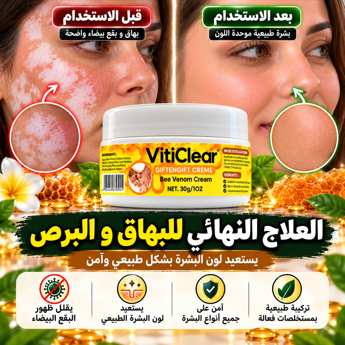 كريم المركز لعلاج البهاق و البرص VITICLEAR